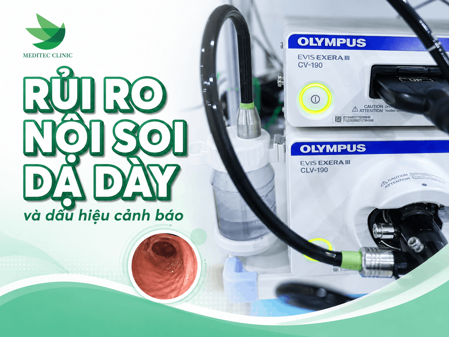 Rủi ro nội soi dạ dày và dấu hiệu cảnh báo