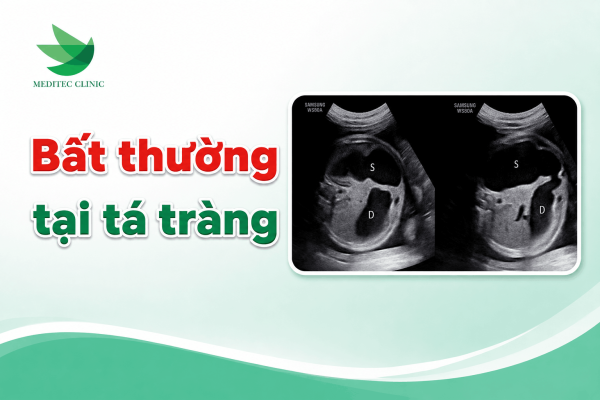 Bất thường tại tá tràng