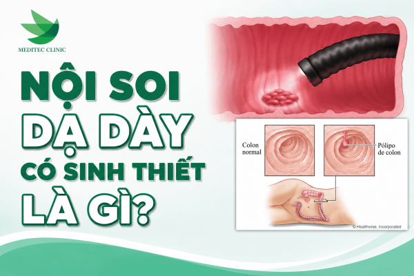 Kỹ thuật nội soi dạ dày có sinh thiết là gì?