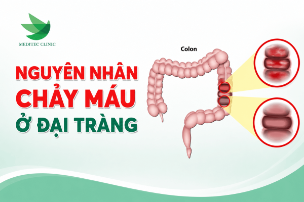Nguyên nhân chảy máu ở đại tràng