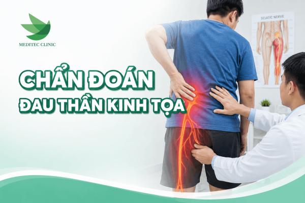 Chẩn đoán đau thần kinh tọa