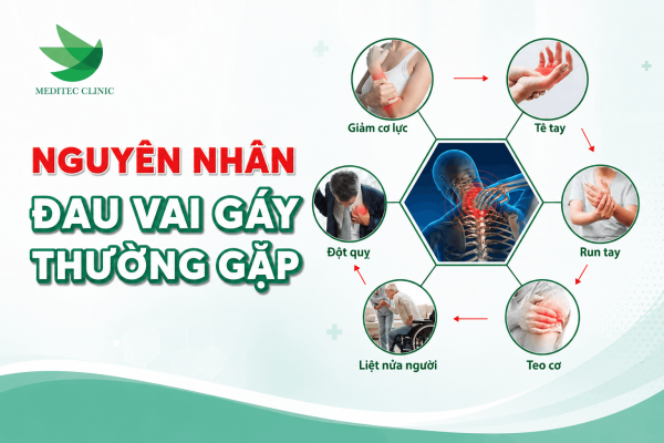 5 nguyên nhân đau vai gáy thường gặp