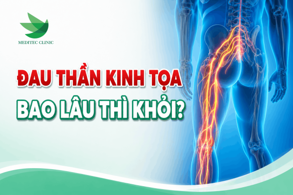 Đau thần kinh tọa bao lâu thì khỏi?