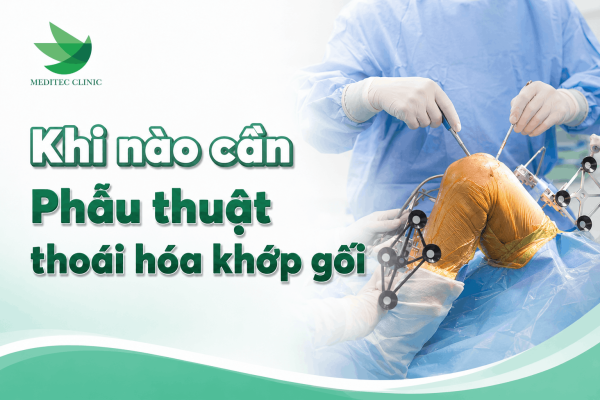 Khi nào thoái hóa khớp gối cần cân nhắc phẫu thuật thay khớp gối?