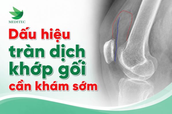 Tràn dịch khớp gối: 5 dấu hiệu cần khám sớm