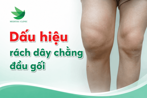 Dấu hiệu cần khám phục hồi chức năng sớm