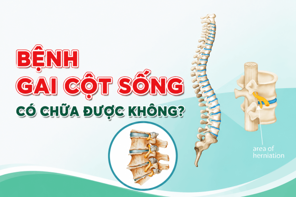 Bệnh gai cột sống có chữa được không?