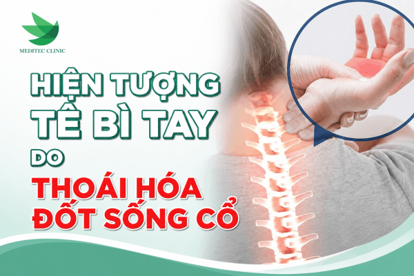 Giải đáp nhanh: Hiện tượng tê bì tay do thoái hóa đốt sống cổ?