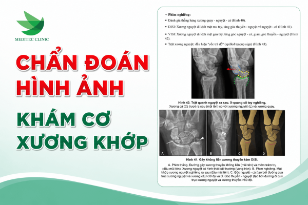 Khẳng định tê bì tay do thoái hóa đốt sống cổ