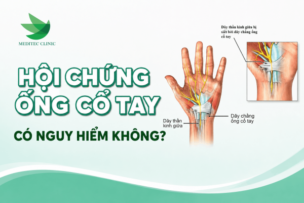 Hội chứng ống cổ tay có nguy hiểm không? 