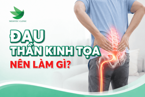 Đau thần kinh tọa nên làm gì?